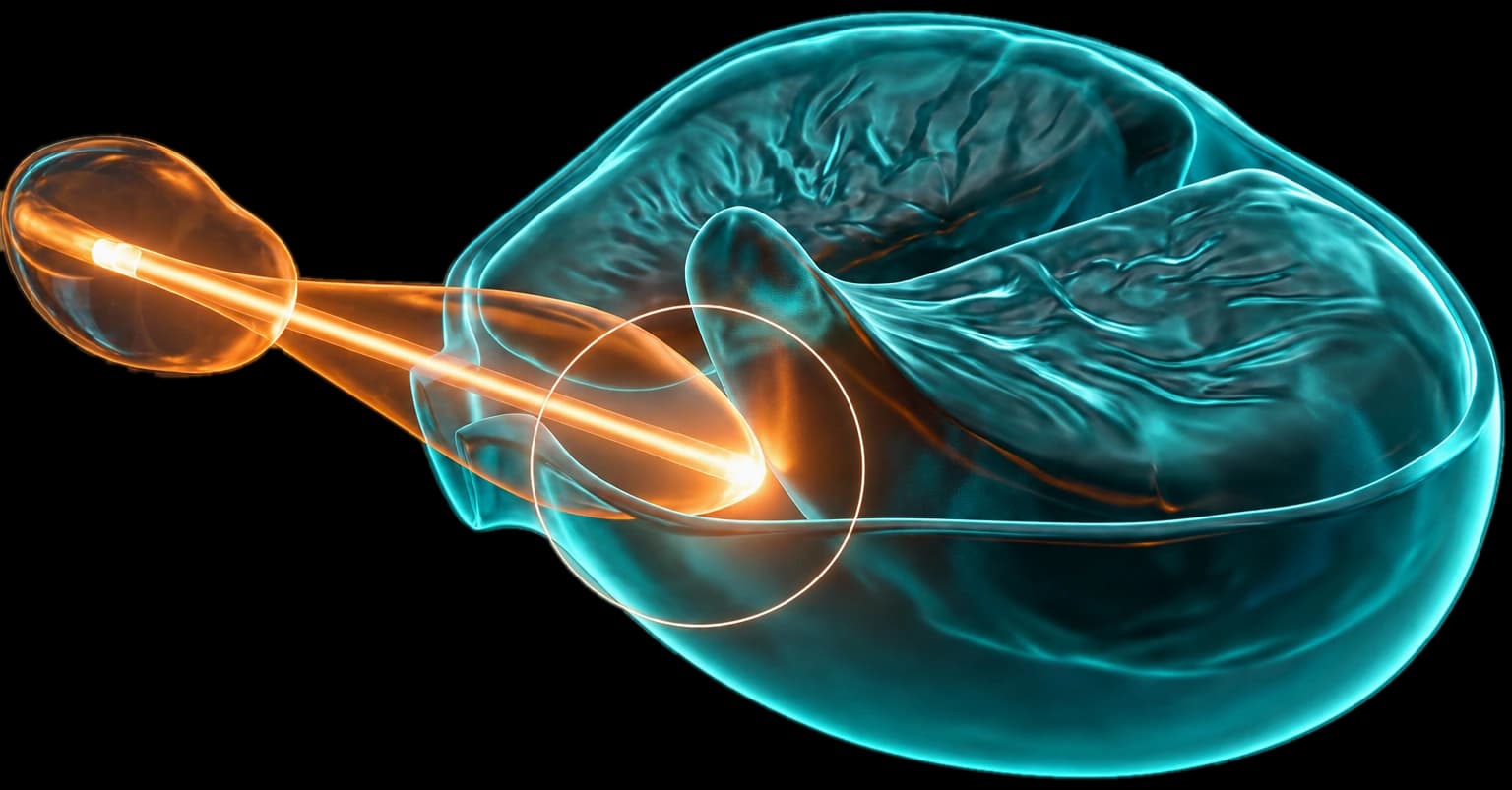 Ilustração 3D da próstata em corte com a fibra de laser entrando pela uretra para enuclear o tecido que obstrui o canal da urina